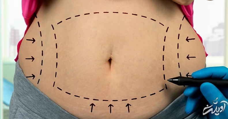 ابدومینوپلاستی سعادت آباد